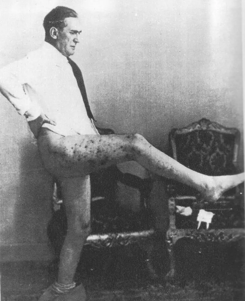 Viceroy Rodolfo Graziani showing his leg injuries caused by grenade fragments.